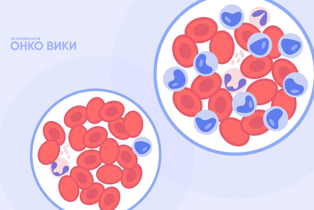 «Самый распространенный вид рака у детей»: вышел онлайн-справочник о детских лейкозах