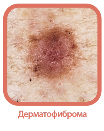 Дерматофиброма.png