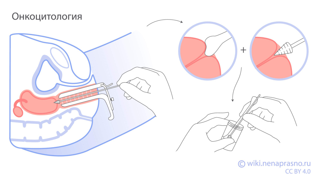 Онкоцитология, Пап-тест.jpeg