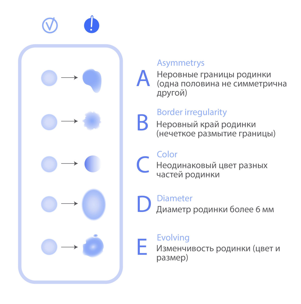 Как заподозрить меланому, wiki.nenaprasno.ru.JPG
