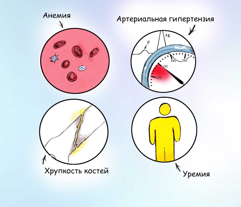 Поликистоз почек2.jpg