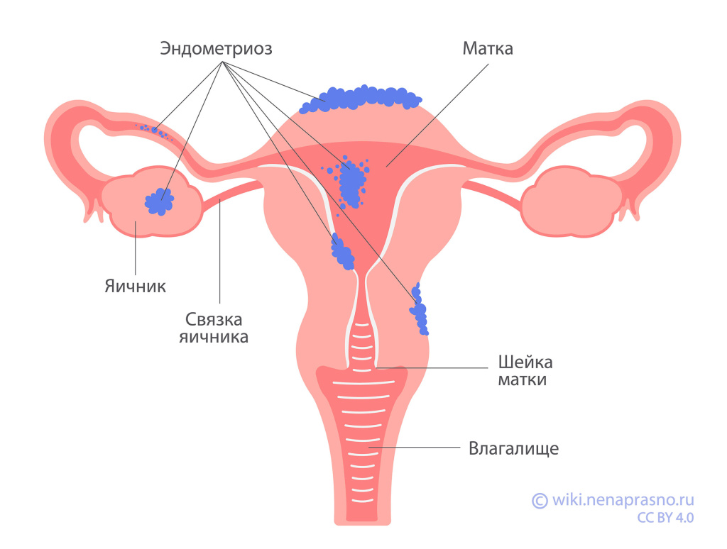 Эндометриоз.jpg Эндометриоз.jpg