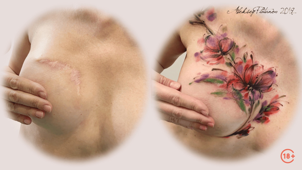 Перекрытие шрама на груди после операции.jpeg Перекрытие шрама на груди после операции.jpeg