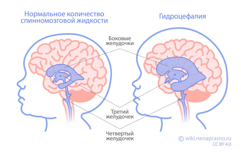 Опухоли ЦНС у детей_OncoWiki.jpeg