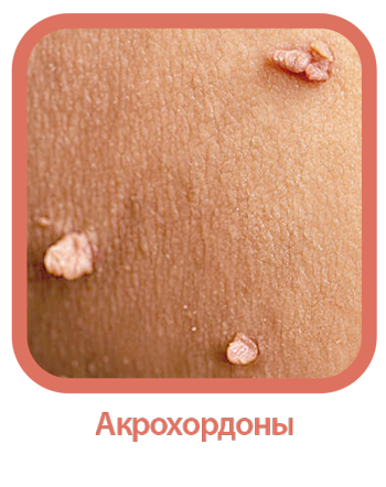 Фибромы, акрохордоны.png