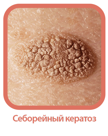 Себорейный кератоз.png Себорейный кератоз.png