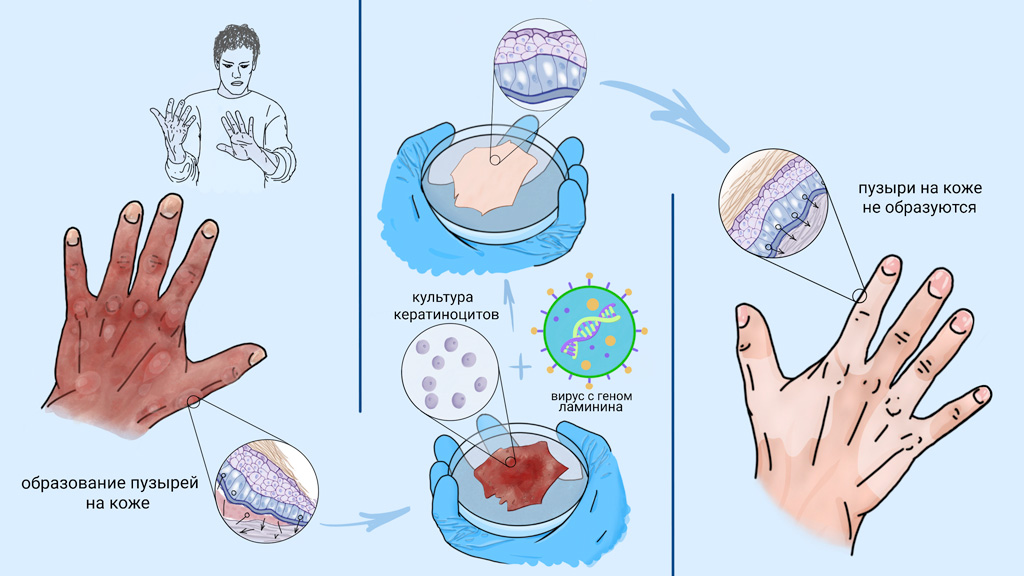 Буллезный эпидермолиз.jpg Буллезный эпидермолиз.jpg