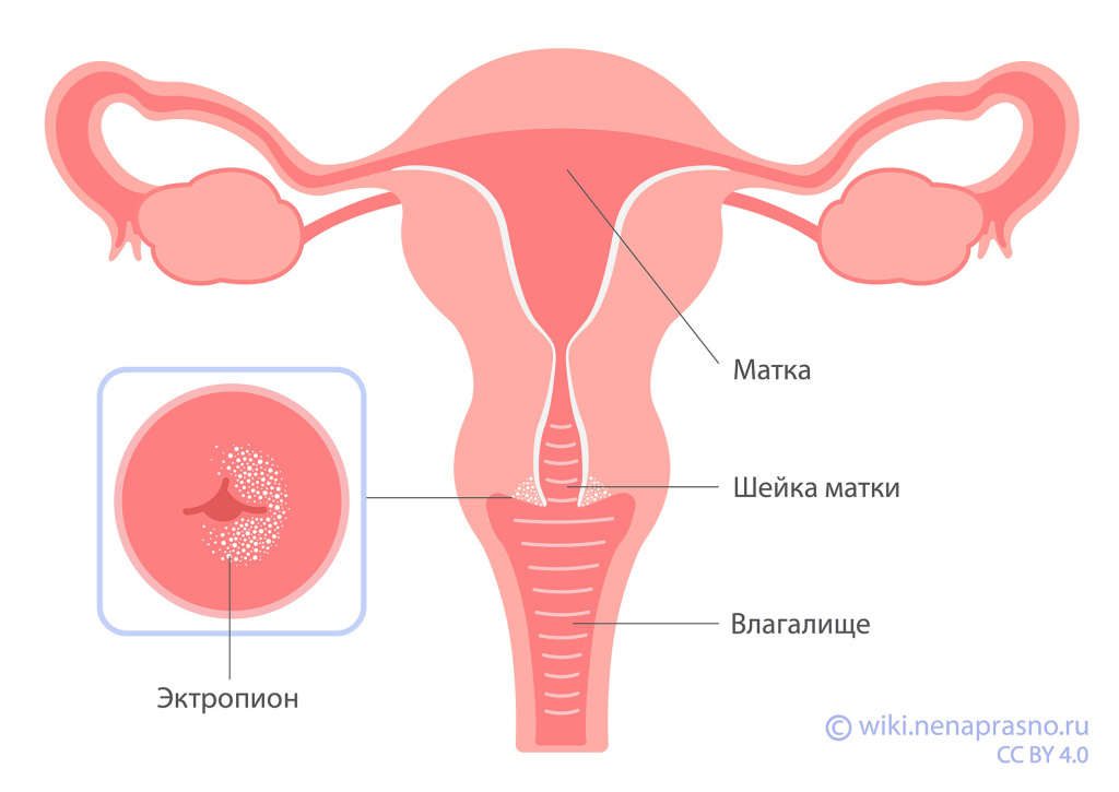 Эктропион.jpg Эктропион.jpg