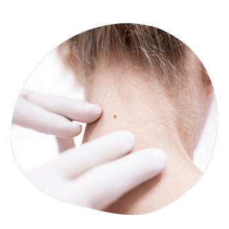 Что такое меланома.png