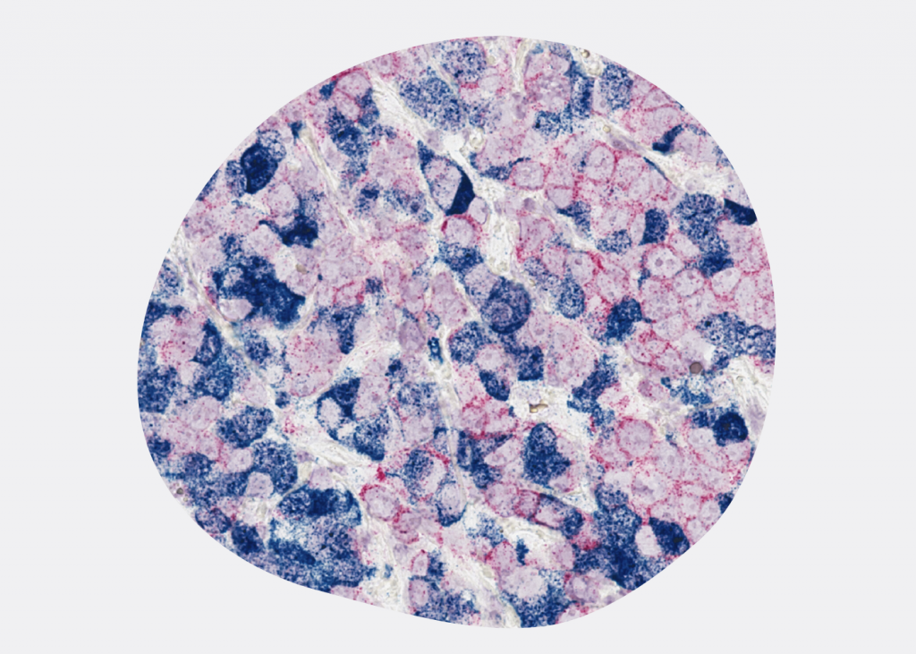 Рак молочной железы