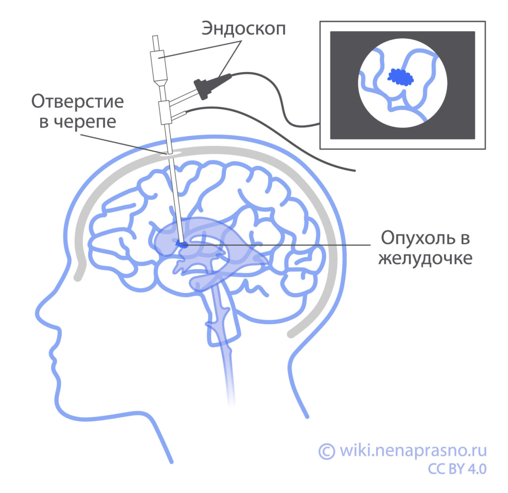 Опухоли ЦНС у детей_OncoWiki..jpeg
