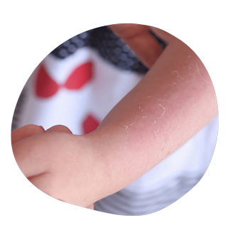 Солнечные ожоги у ребенка.png