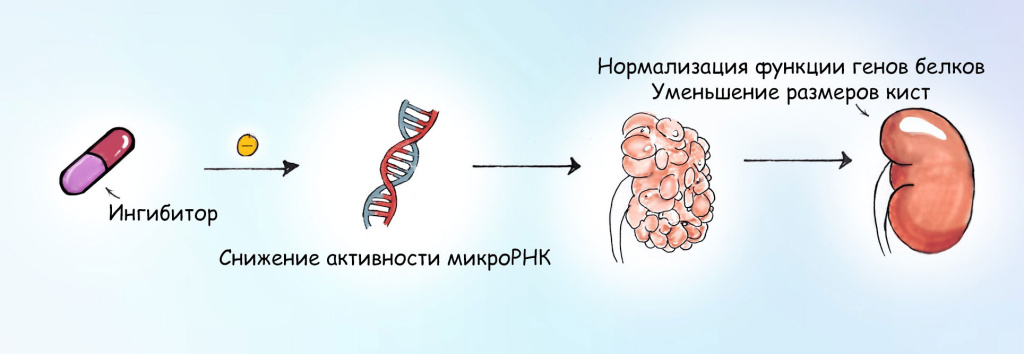 Поликистоз почек 4.jpg