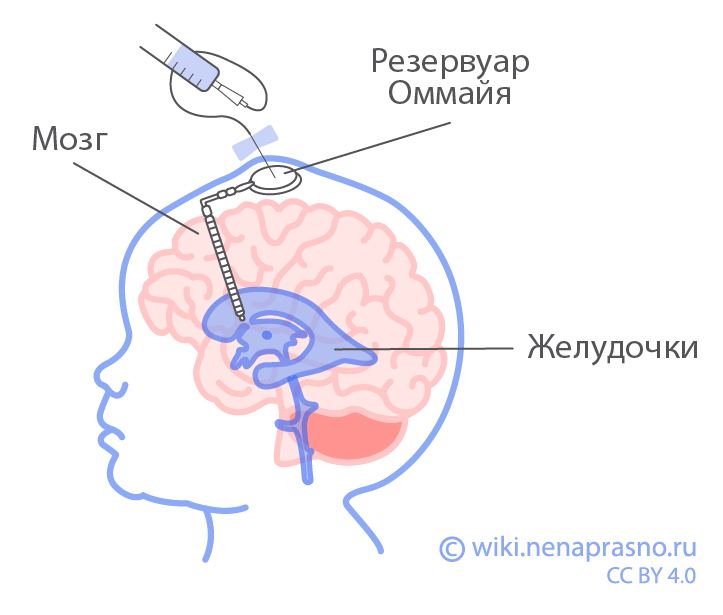 Резервуар Оммайя_ОнкоВики.jpeg