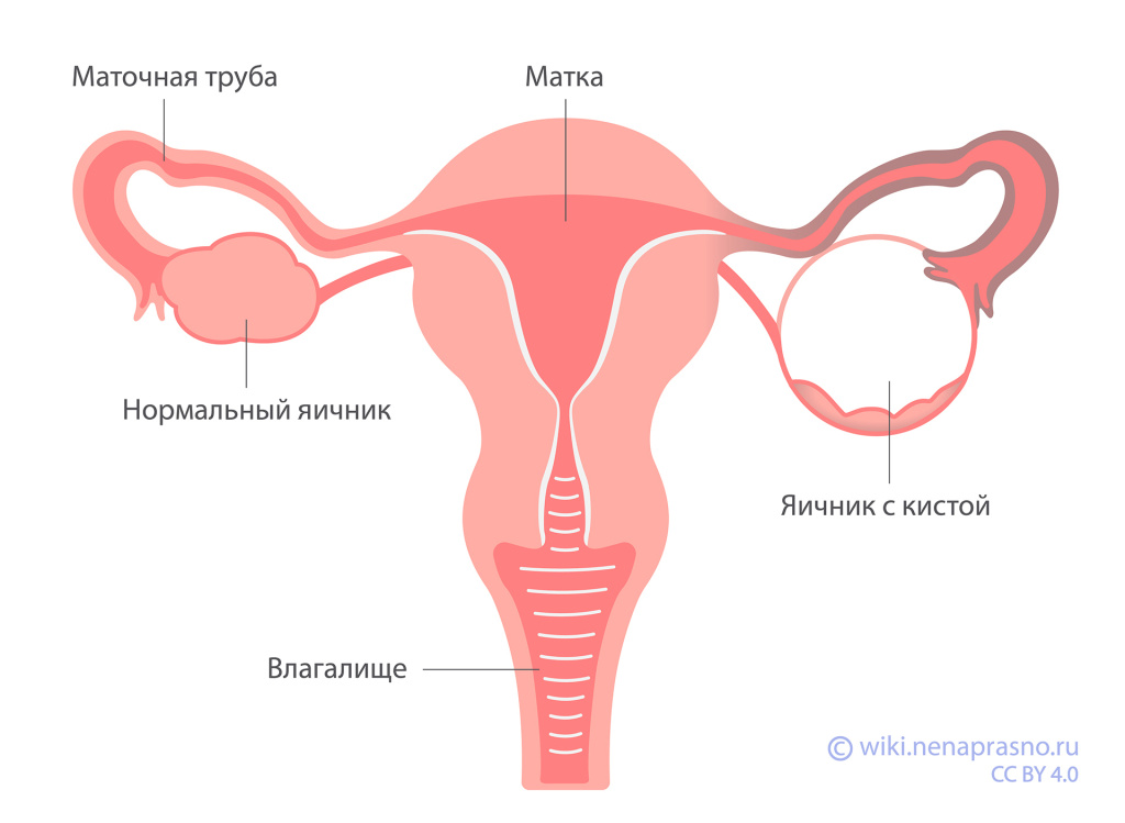 Киста яичника.jpg Киста яичника.jpg