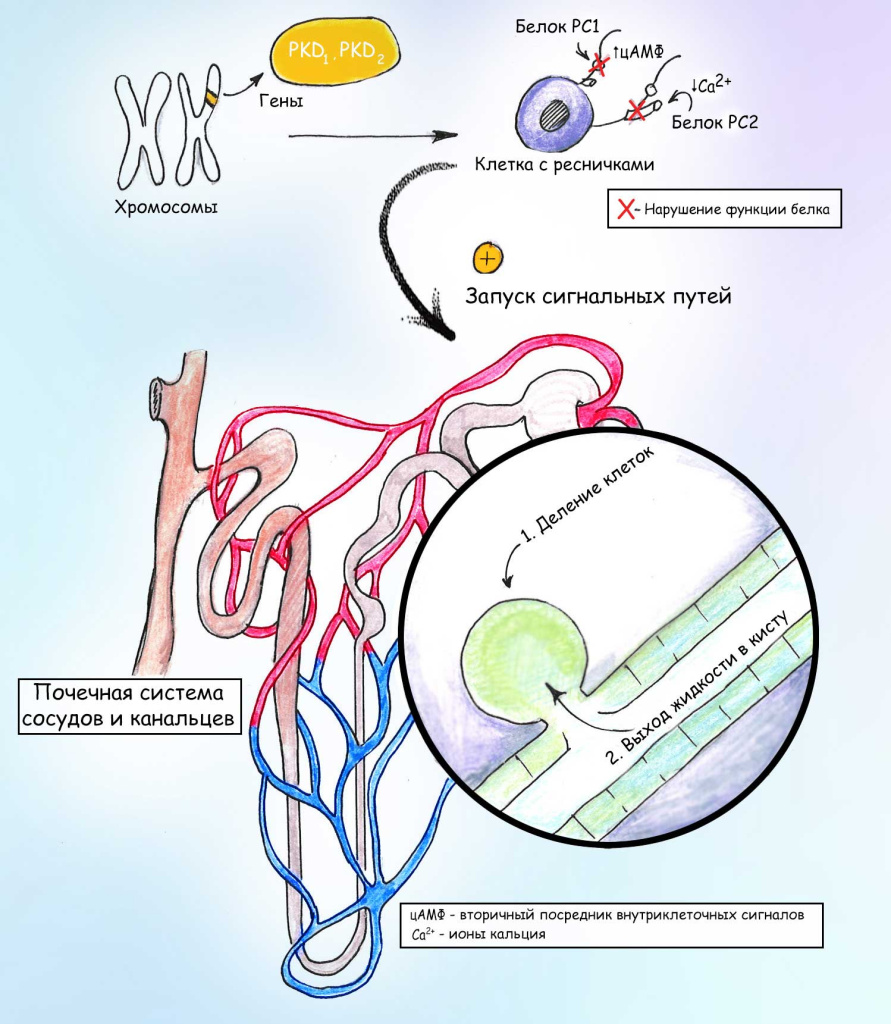 Поликистоз почек3.jpg