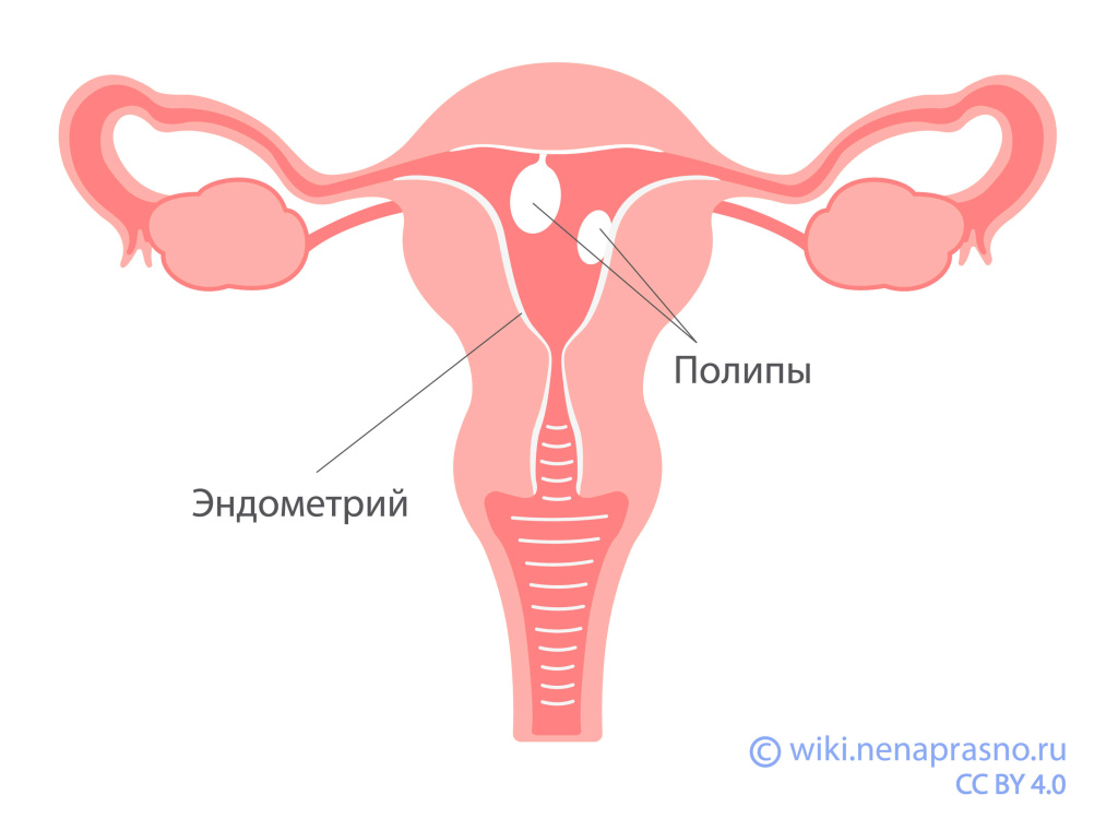 Полипы эндометрия.jpeg Полипы эндометрия.jpeg