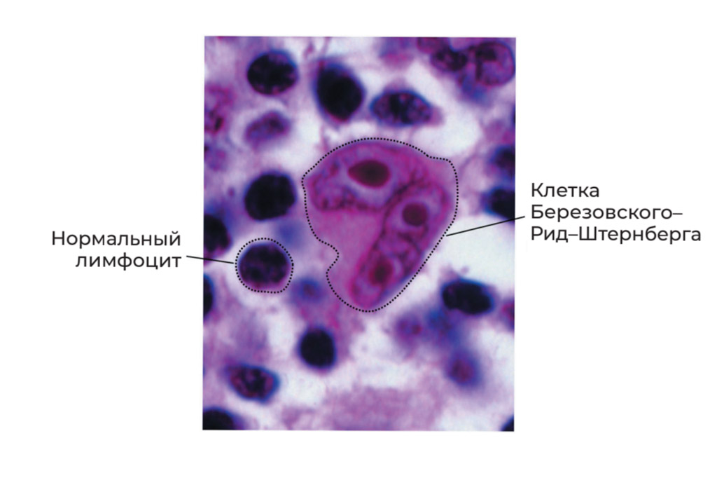 Клетки-Березовского-Рид-Штенберга-в-лимфатическом-узле.jpg