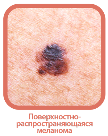 Меланома.png