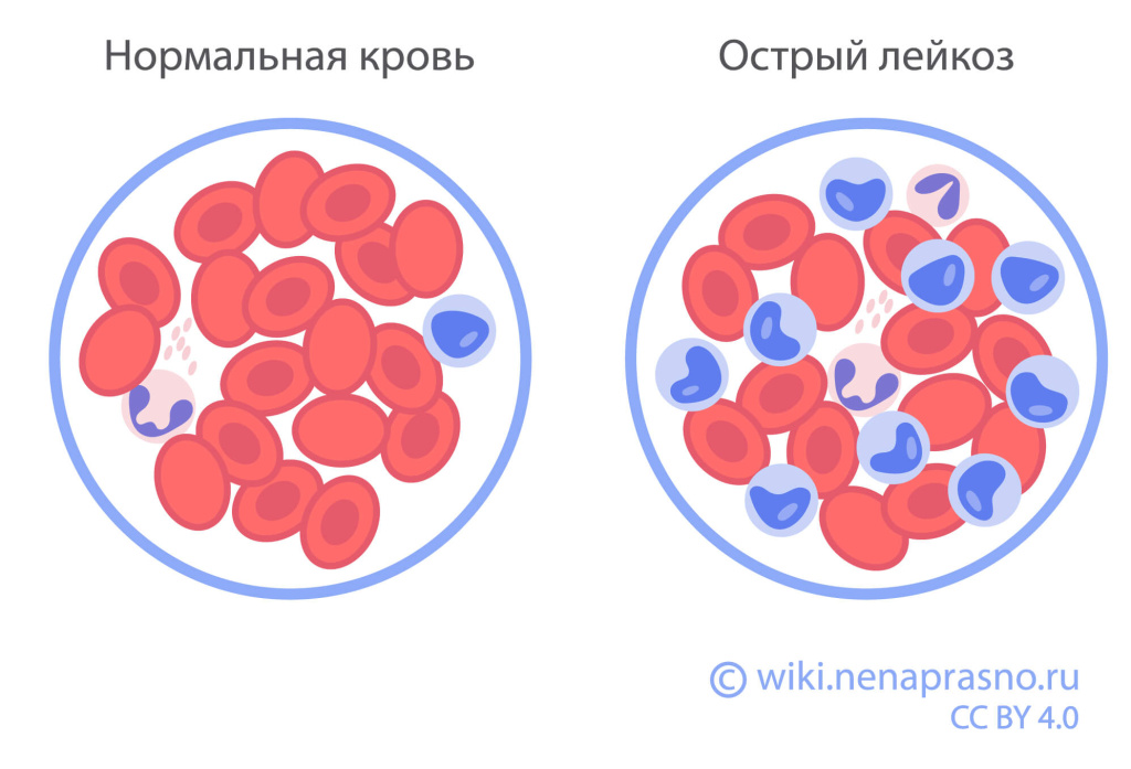 Лейкозы у детей.jpeg