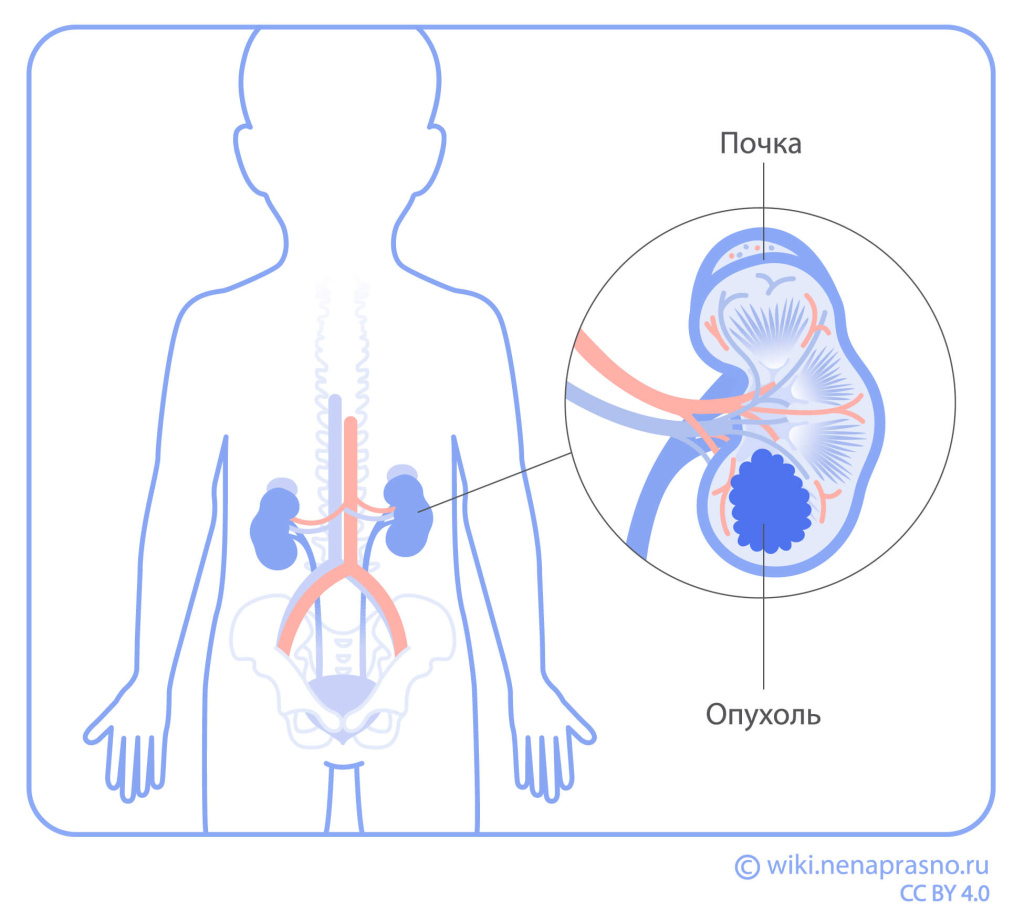 Опухоли почки у детей_Онко Вики.jpg
