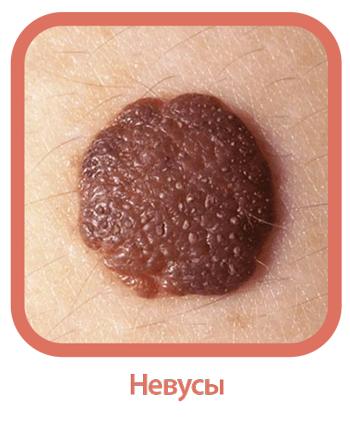 Невусы.png Невусы.png