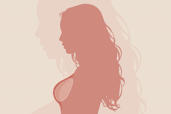 Импланты и рак молочной железы: есть ли связь и как нужно обследоваться