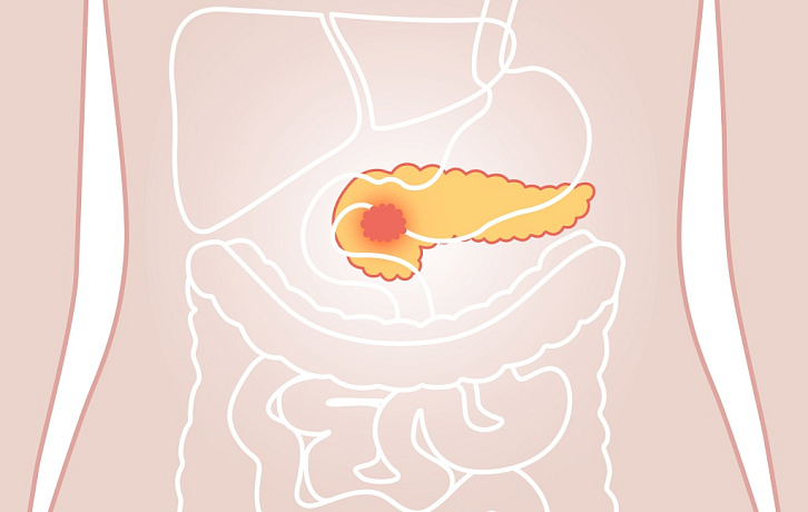 «На первых стадиях симптомов обычно нет»: что нужно знать о раке поджелудочной железы