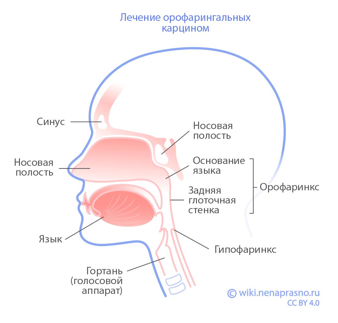 Орофарингеальная карцинома.jpg