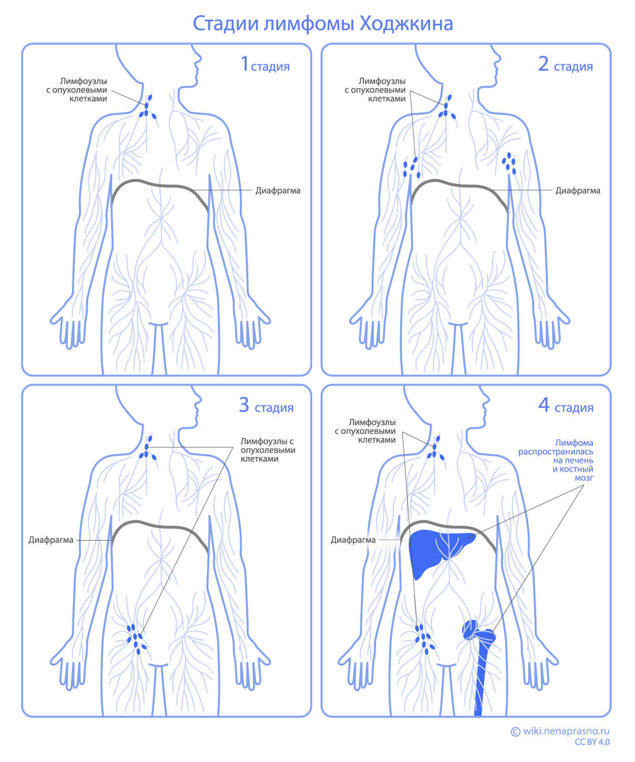 Стадии лимфомы Ходжкина.jpg