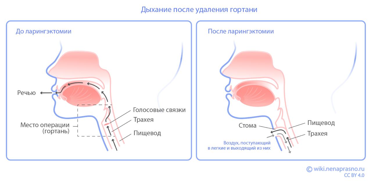 Дыхание после удаления гортани.jpg