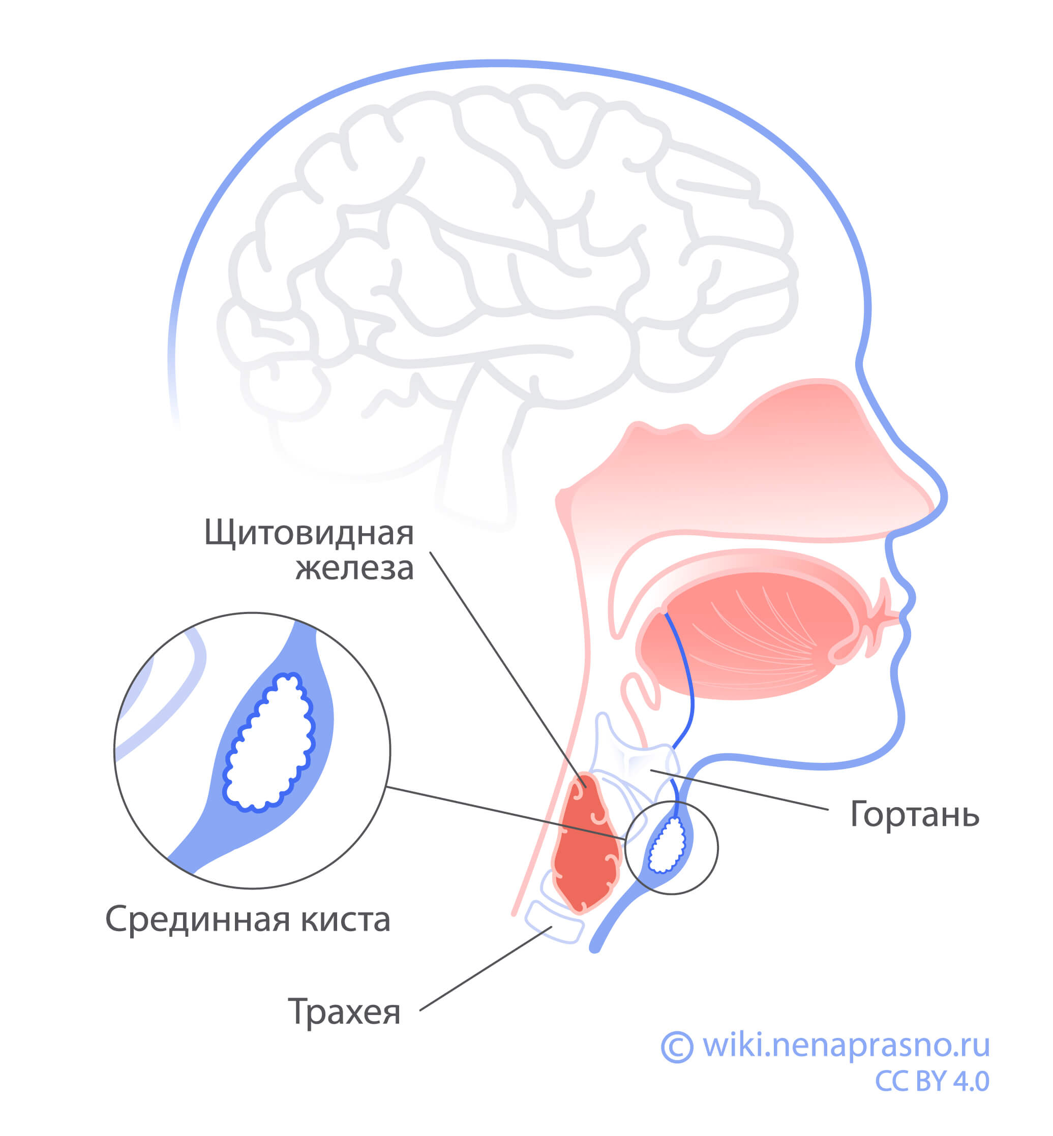 Срединная киста.jpg Срединная киста.jpg