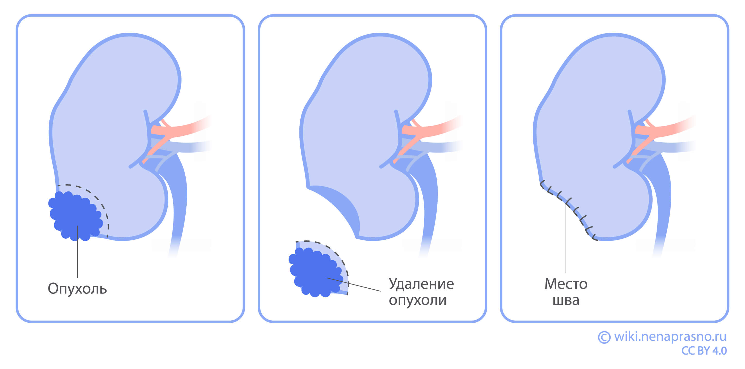 Удаление опухоли.jpg Удаление опухоли.jpg