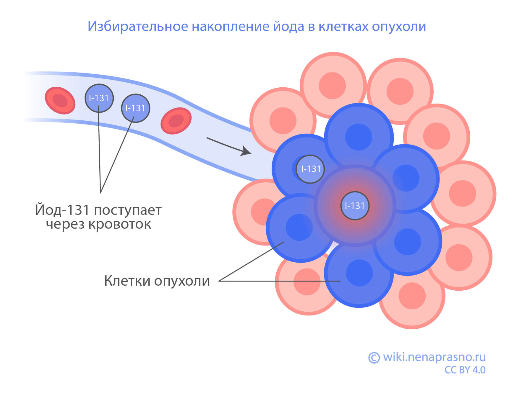 Лечение радиоактивным йодом.jpg Лечение радиоактивным йодом.jpg