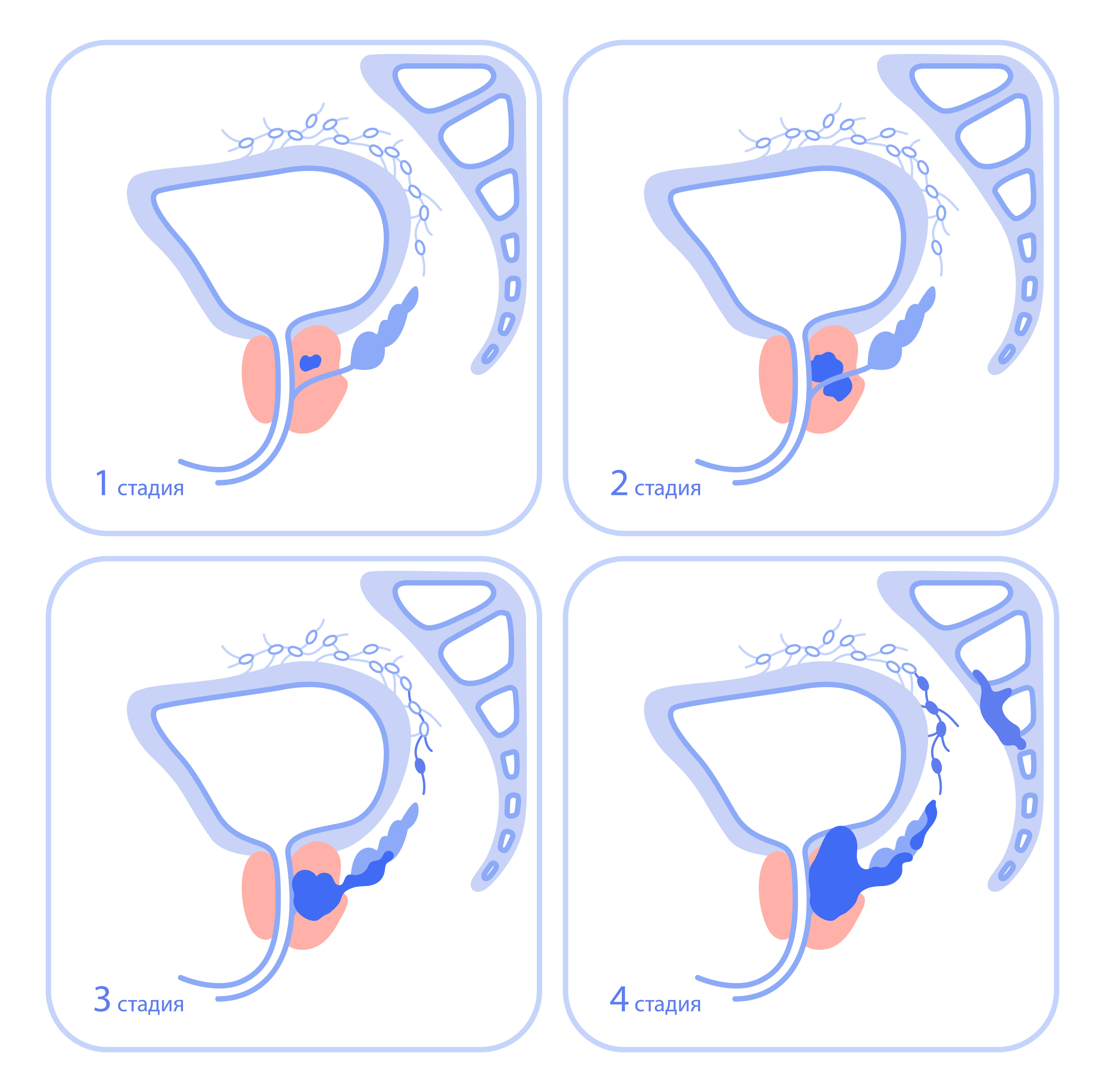 Стадирование онкологических заболеваний TNM.jpeg