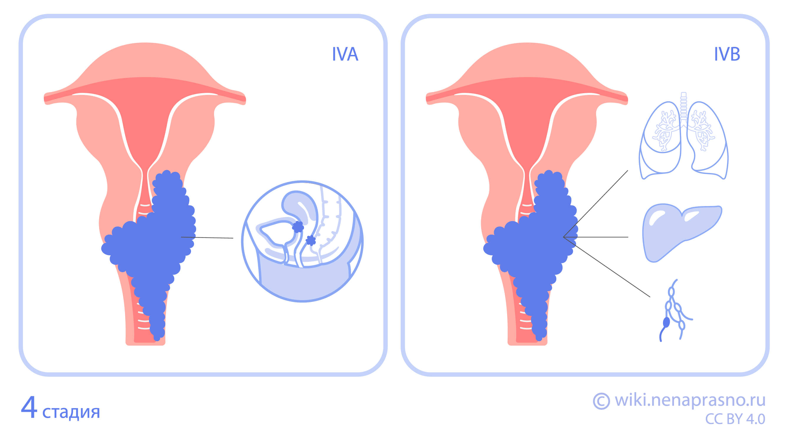 Стадии рака шейки матки