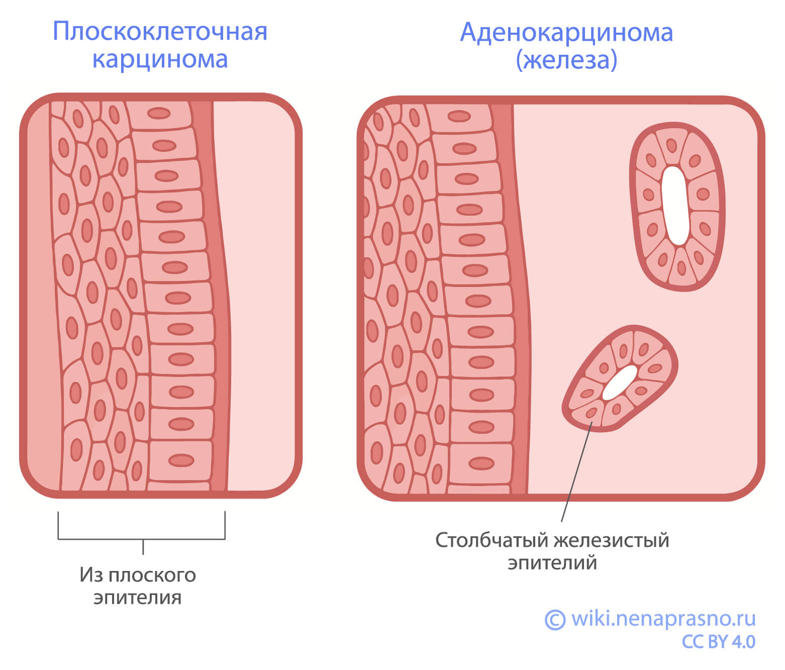 Carcinoma.jpg Carcinoma.jpg