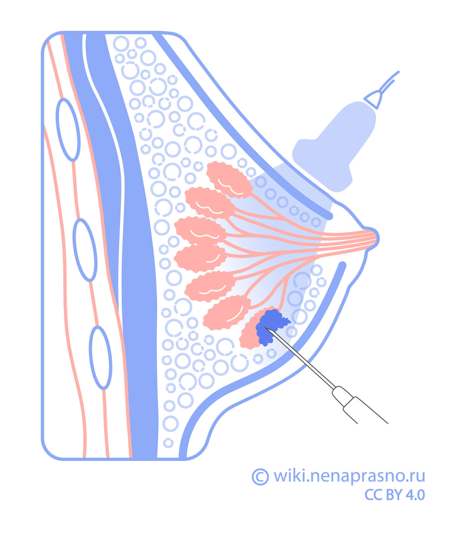 Биопсия при подозрении на рак молочной железы