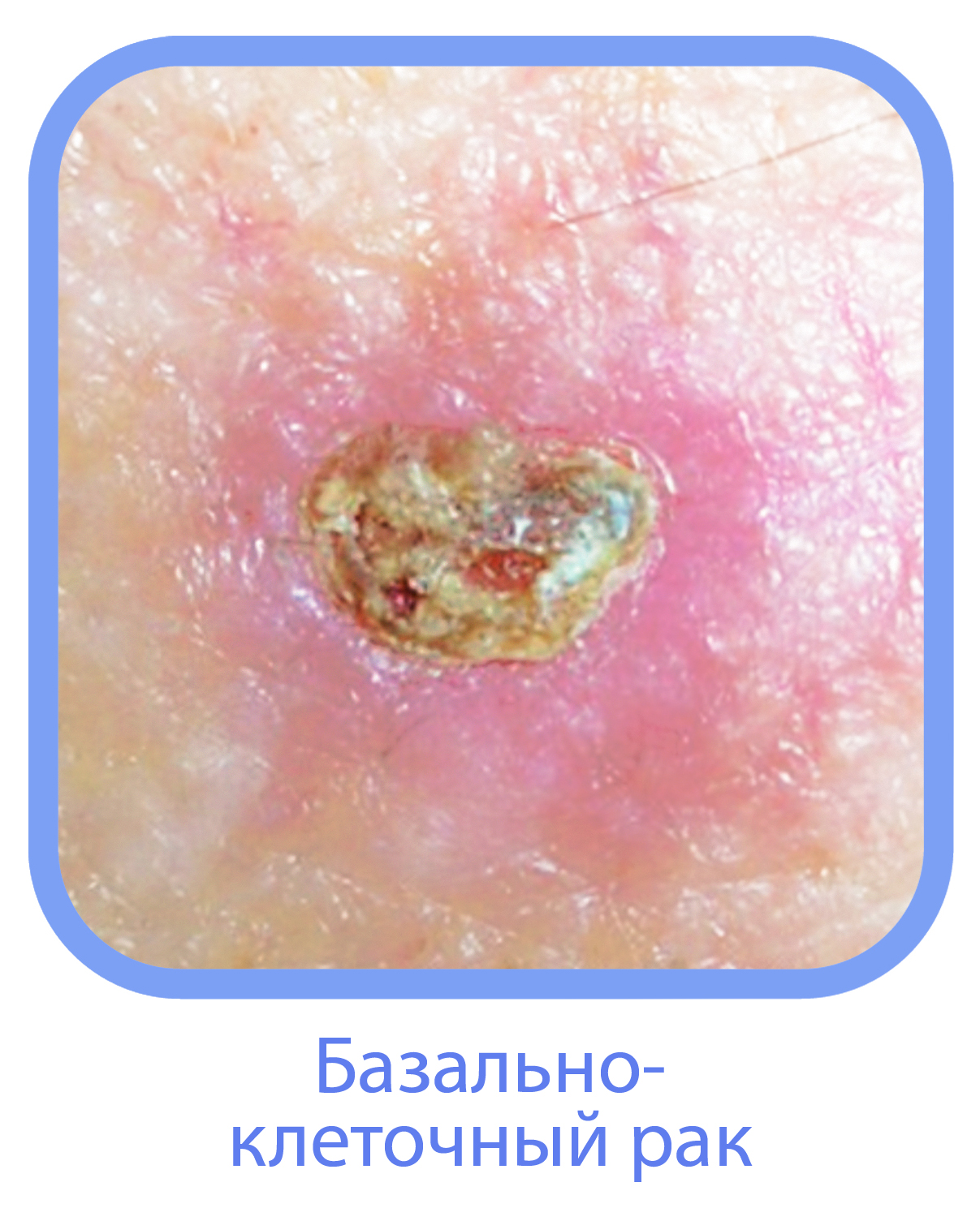 Какие онкологические заболевания возникают на коже?