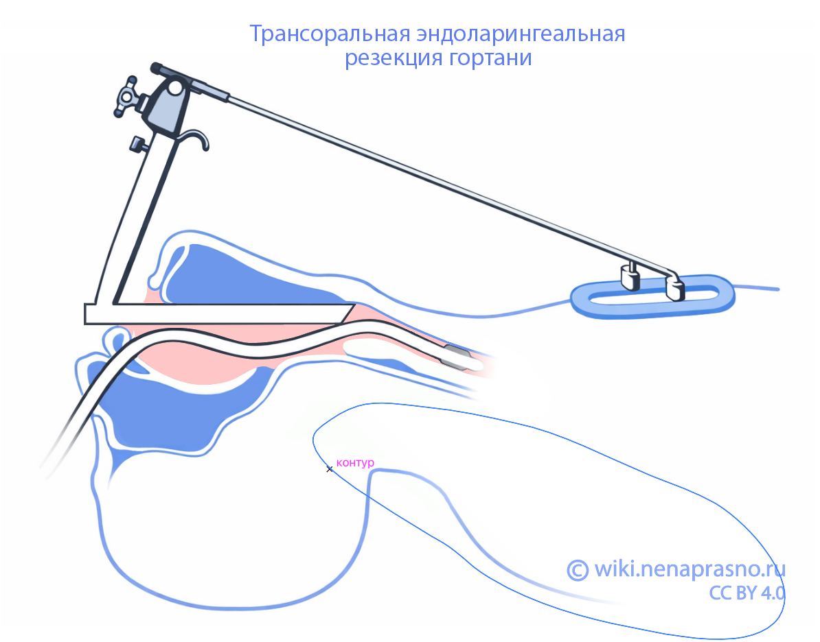 Трансоральная резекция.jpg
