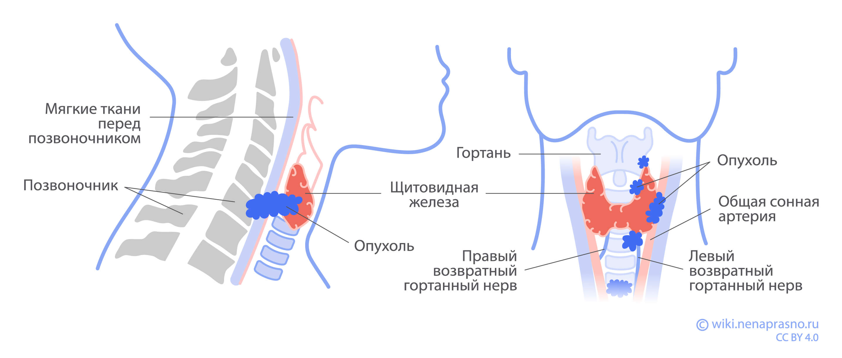 Опухоли щитовидной железы.jpg Опухоли щитовидной железы.jpg