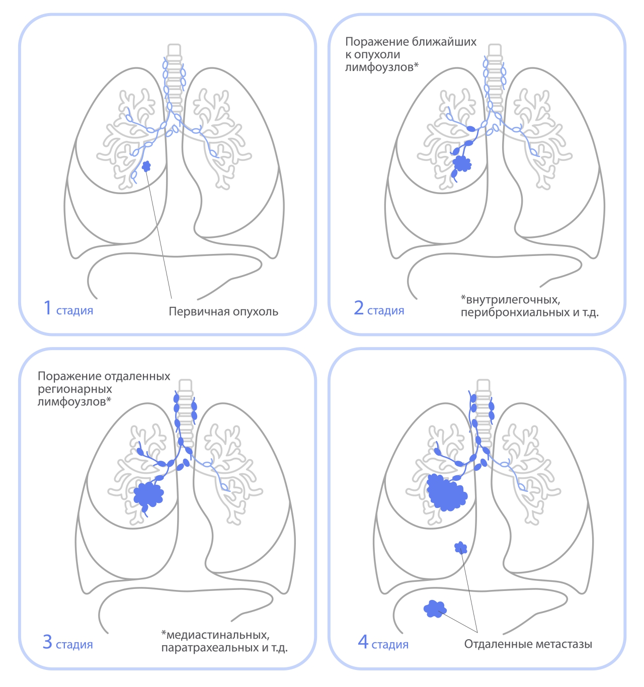 Стадии рака легкого