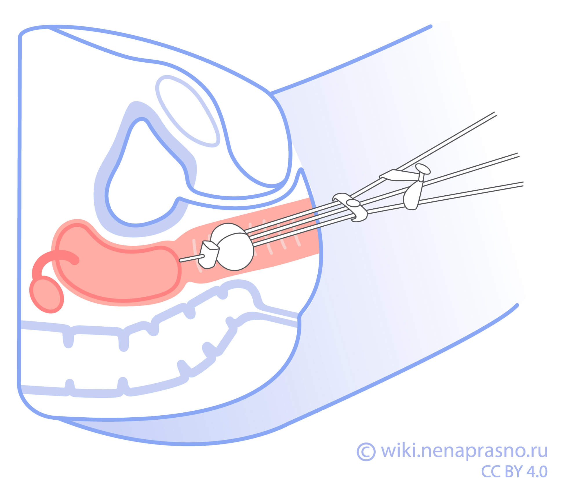 Лучевая терапия при раке шейки матки