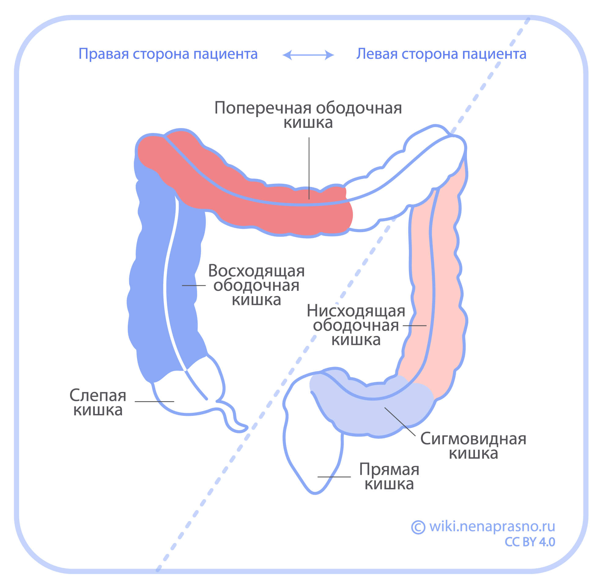 Анатомические формы колоректального рака
