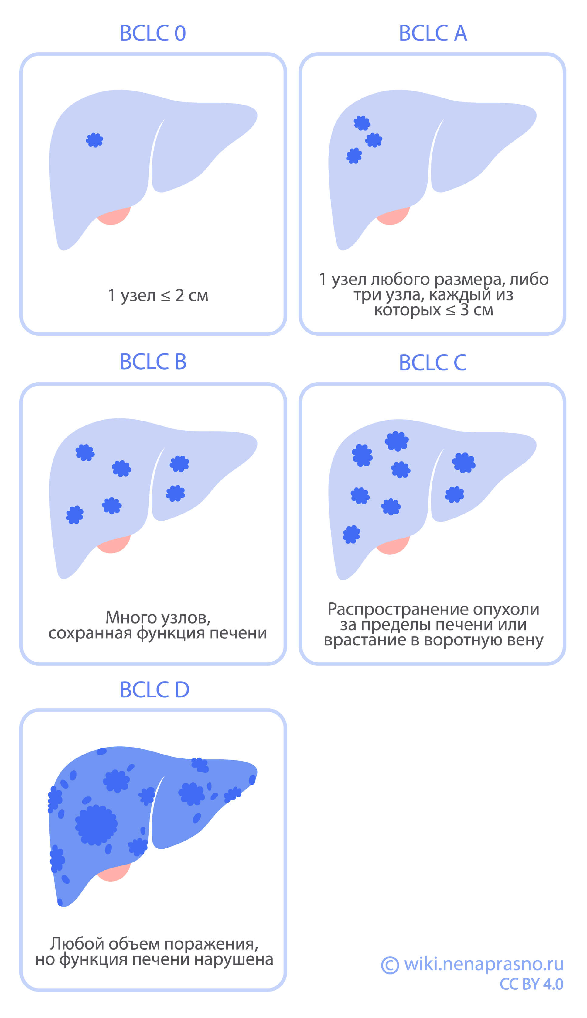 Стадии рака печени