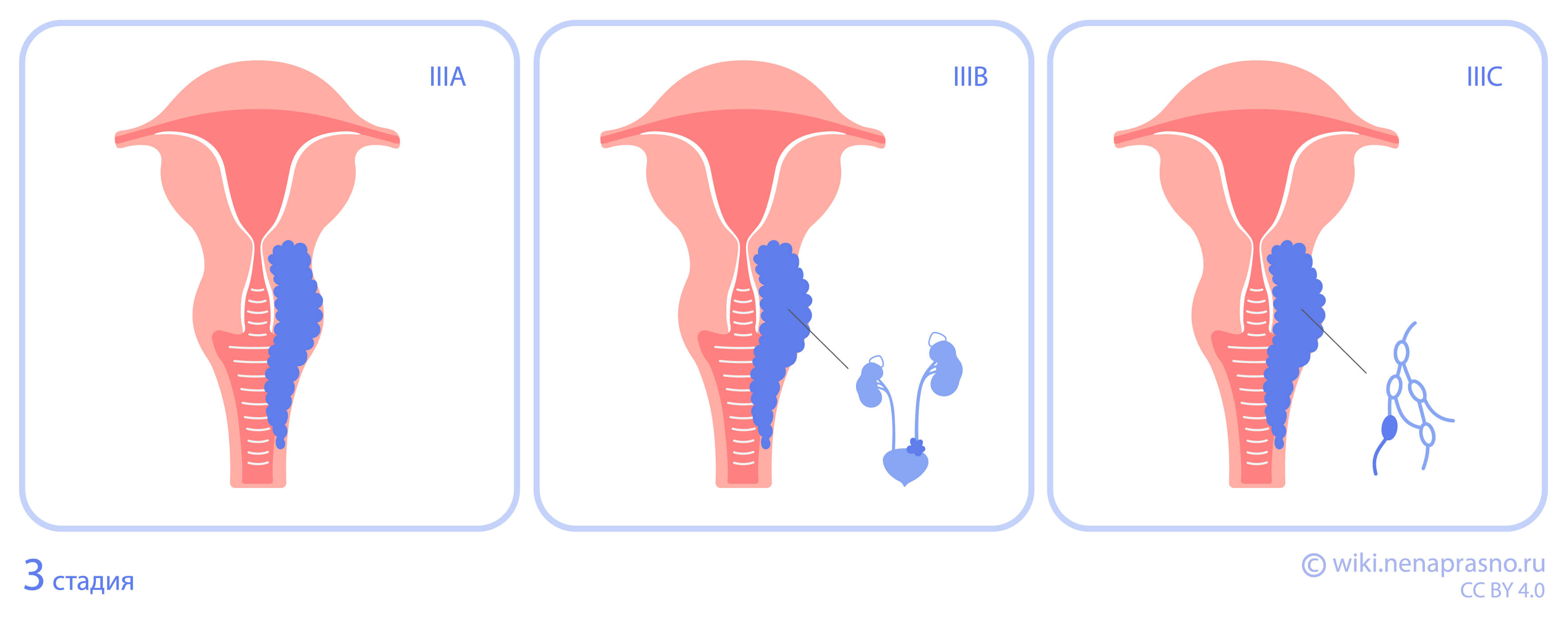 Стадии рака шейки матки