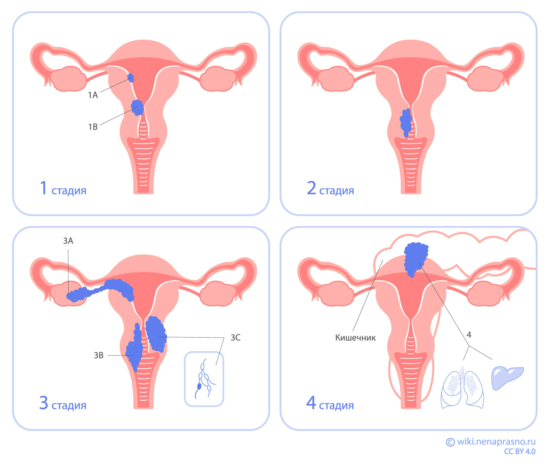 Стадии рака эндометрия