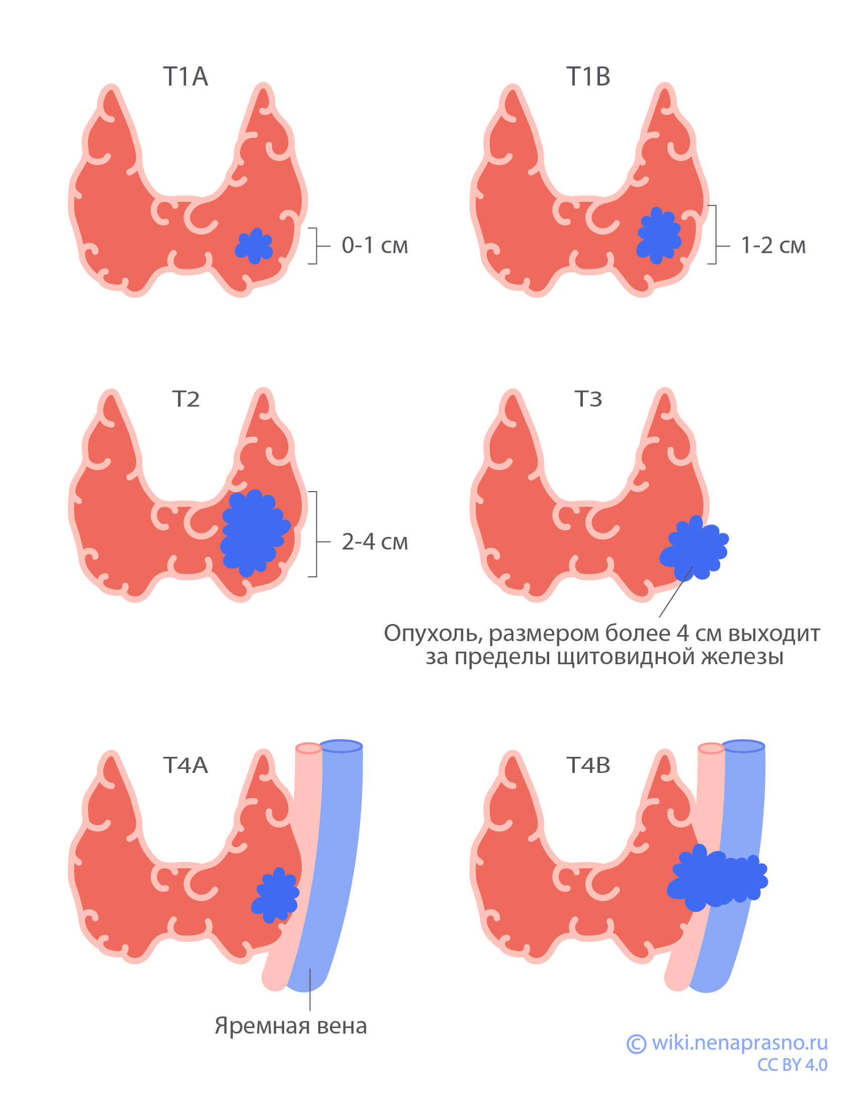 Размеры опухоли щитовидной железы.jpg Размеры опухоли щитовидной железы.jpg