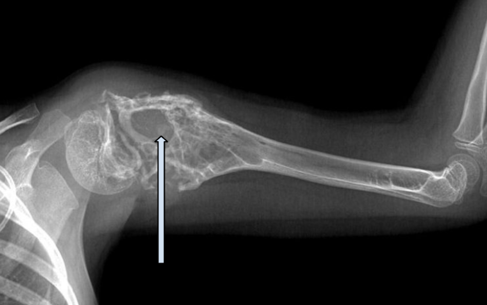 Костная саркома.png