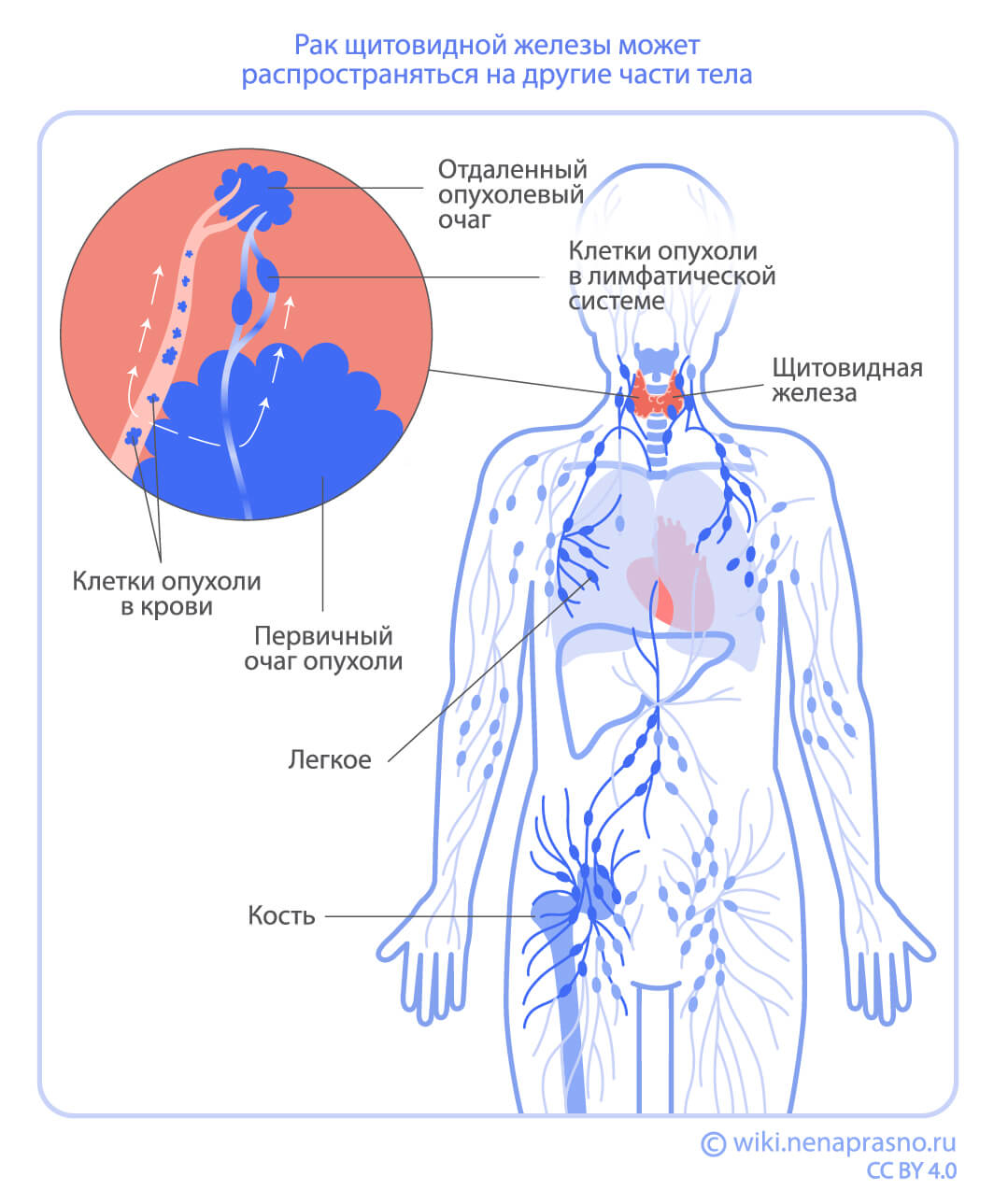 Распространение рака щитовидной железы.jpg Распространение рака щитовидной железы.jpg
